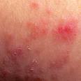 Eczma de laposadulte - Dfinition, Causes, Traitement