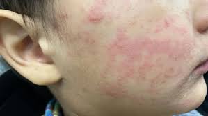 Pa. hospital limits visitors to NICU because of potential measles exposure