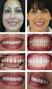 #4-11 &amp; #22-27 IPS e.max Pressed Layered Veneers, #3, 12-14, 19, 30, 31 IPS e.max Monolithic Onlays. Case Studies &middot; Implant Cases &middot; Dr. Vicki Cohn – Chatham ... - ahlowalia-veneercase-montage