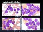 Aspirado de medula osea en nio con leucemia -