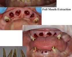 Image of Wisdom teeth removal
