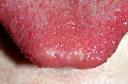 Tongue Problems: Sores, Discoloration, and Tongue Bumps - WebMD