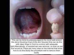 Image result for tonsilith