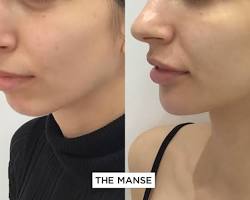Dermal fillers for chin