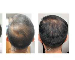 Image of PRP Therapy for hair loss