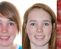 Image de Avantaprès un traitement orthodontique