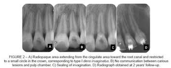 Résultat de recherche d'images pour "shovel shaped incisors"