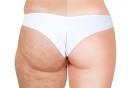 Cellulite: Was gegen Orangenhaut hilft - SPIEGEL ONLINE