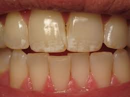 Image result for fluorosis