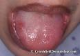 Canker Sore (Aphthous Ulcer) in Adults: Condition, Treatment and