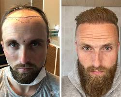 Изображение: Hair transplant before and after