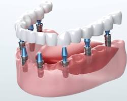 Dental implants can help to improve your bite