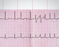 Image of Fibrilație atrială EKG