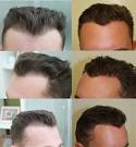 Fue haartransplantation erfahrungen