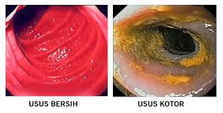 Hasil gambar untuk usus tidak sehat