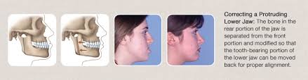 Image result for jaw surgery