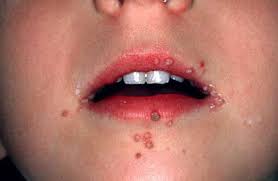 Znalezione obrazy dla zapytania hpv