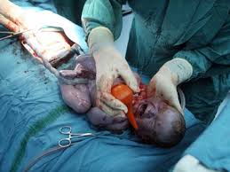 Image result for delivery baby