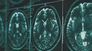 ¿Cuáles son los primeros signos del Alzheimer? Diagnóstico del piloto del 