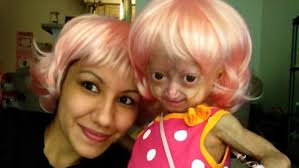 Resultado de imagen para progeria adalia rose