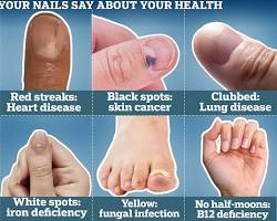 Vitamin deficiency nails