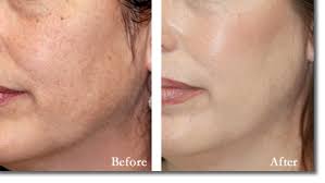 Image result for jessner acid peel