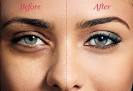 Under eye puffiness treatments