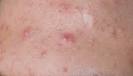 Accutane Acne treatment, side effects, risk, caution, danger