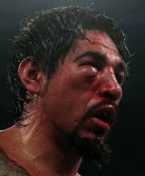 In 36 minutes he went from looking like a smooth hipster to the parking attendant in Ferris Bueller&#39;s Day Off. Pac Man straight up rearranged his face. - antonio-margarito-eye2