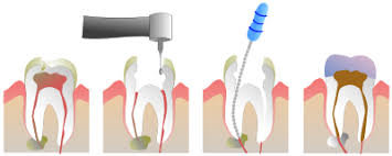 Image result for Endodontics