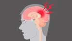  Concussion more complex than just a head injury