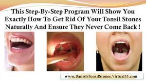 Image result for tonsil stones