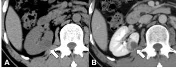 “Analysis of the Radiological Characteristics of Small Renal Cell Carcinoma on Unenhanced CT Scans”
