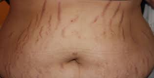 Image result for stretch marks