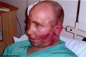 ... off work whilst in hospital for severe cuts and brusies and reconstructive surgery to re-align his nose. But at Bolton Crown Court Judge Timothy Clayson ... - paulhannam1CP_468x315