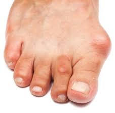 bunions