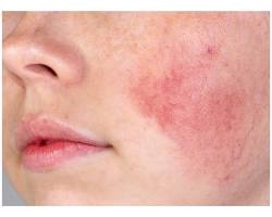 Image of Sensitive Skin