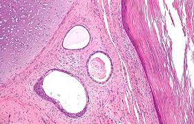 Image result for teratoma