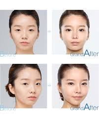 Image result for jaw surgery