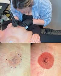 Essex tattooist offers free nipples to cancer patients ...