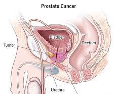 Image of Prostate Cancer