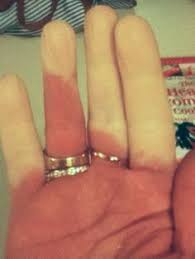 Image result for raynauds photo gif