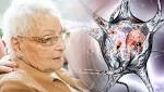  Dementia: Hallucinations and disturbed sleep could be symptoms of this form of disease