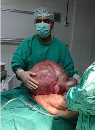 Image result for teratoma