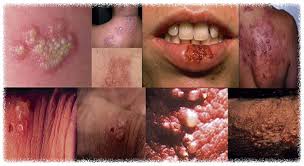 Resultado de imagem para herpes genital