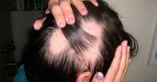 Resultado de imagen para Remedios para calvicie en la mujer o alopecia femenina