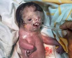 Image result for depleted+uranium+babies