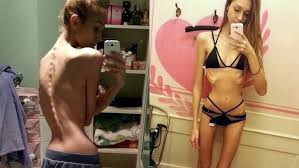 MY ANOREXIA STORY (GRAPHIC) - YouTube