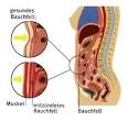 Bauchfellentzündung (Peritonitis Symptome, Diagnose, Therapie)