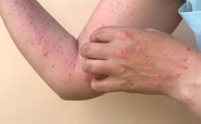 Se disparan contagios de sarampión en México: Salud; febrero reporta mil 902 nuevos contagios